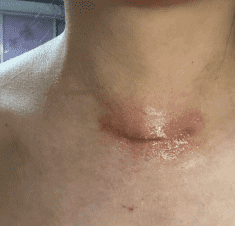 甲状腺手术后仍会再长