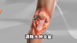 消除水肿炎症示意图